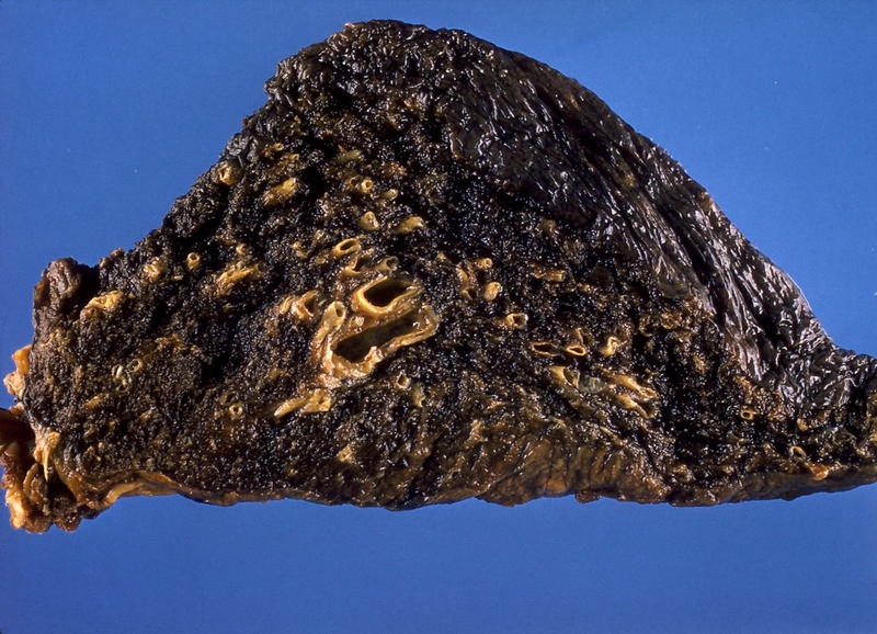 Bụi trong không khí: Bụi càng mịn, tác hại càng lớn 4