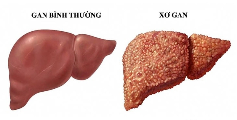 Bụng dưới cứng có nguy hiểm không? -3