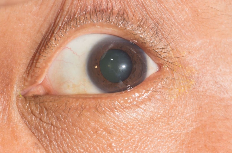 Bước chuẩn bị bệnh nhân và cách thực hiện kiểm tra kích thích phản xạ giác mạc 4