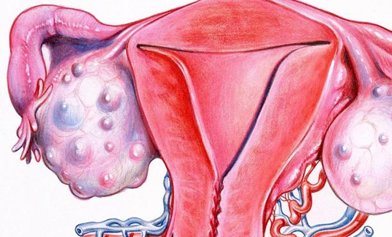 Buồng trứng bình thường có bao nhiêu nang? 2