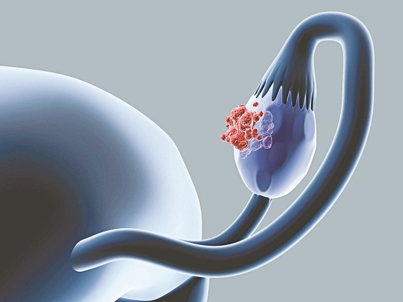 Buồng trứng có nhiều nang nhỏ là dấu hiệu của bệnh gì? 1