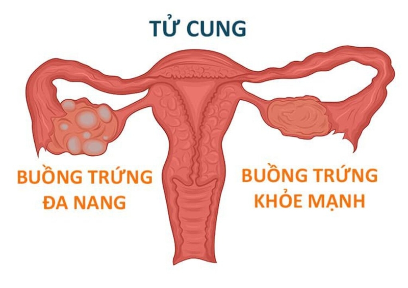 Đa nang buồng trứng 1 bên có thai được không? 1