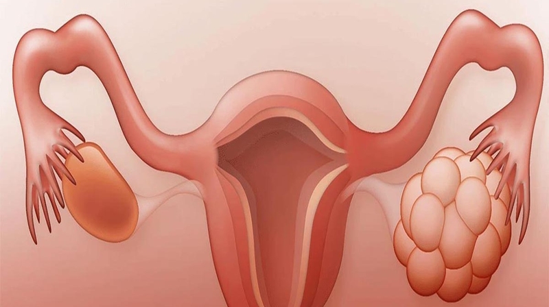 Buồng trứng đa nang có con được không? 2