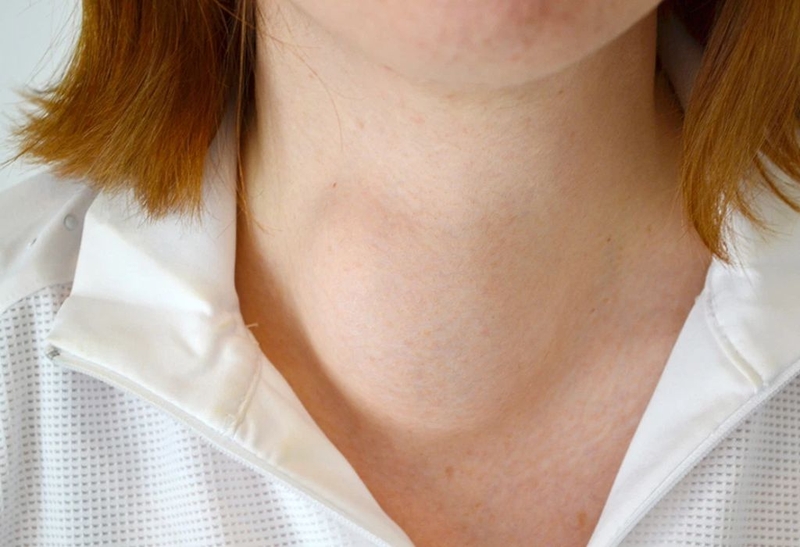 Bướu cổ ăn kiêng gì? Một số thực phẩm nên tránh để chóng hồi phục 1