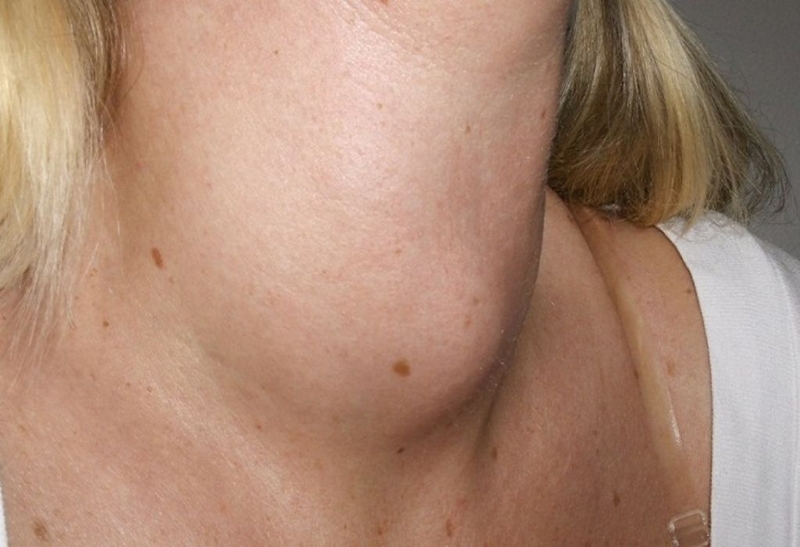 Bướu cổ basedow có mổ được không? Lợi ích và nguy cơ nếu phẫu thuật 1