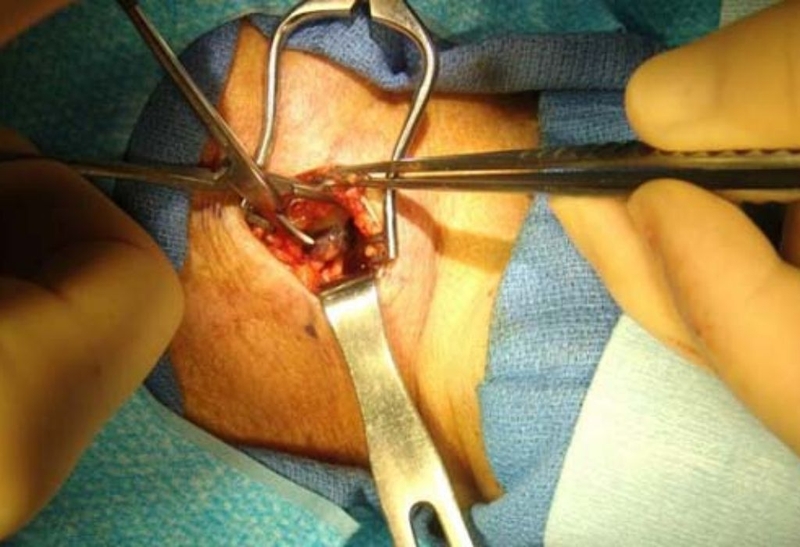 Bướu cổ basedow có mổ được không? Lợi ích và nguy cơ nếu phẫu thuật 2