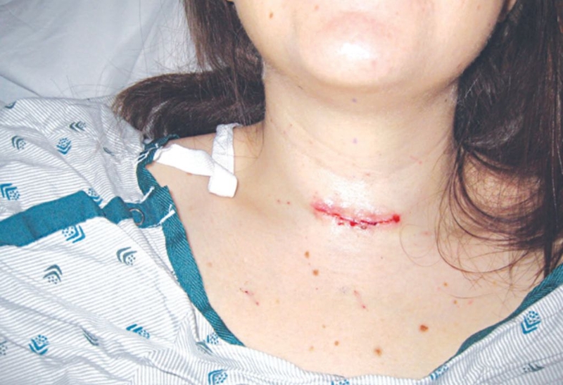 Bướu cổ basedow có mổ được không? Lợi ích và nguy cơ nếu phẫu thuật 3