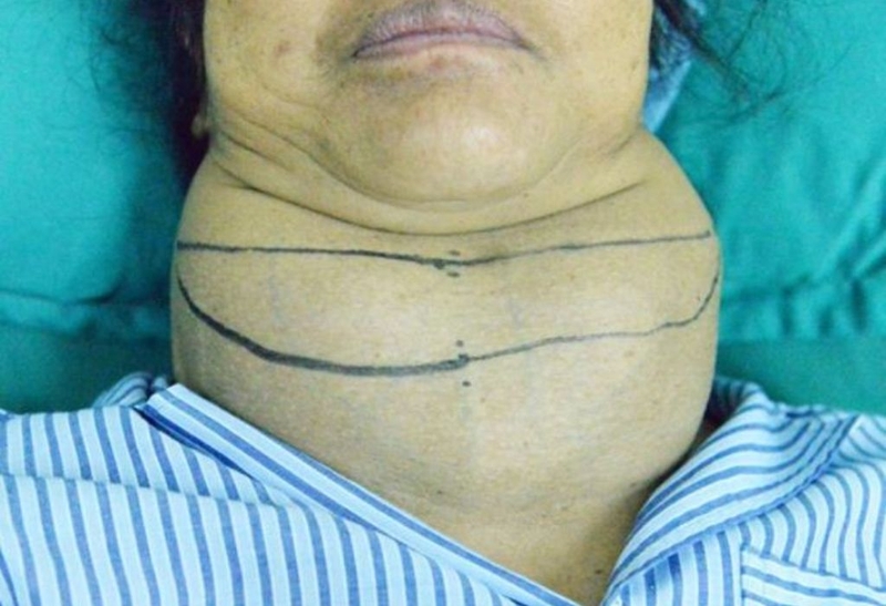 Bướu cổ basedow có mổ được không? Lợi ích và nguy cơ nếu phẫu thuật 4