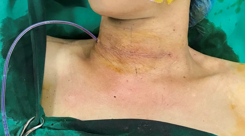 Siêu âm tuyến giáp