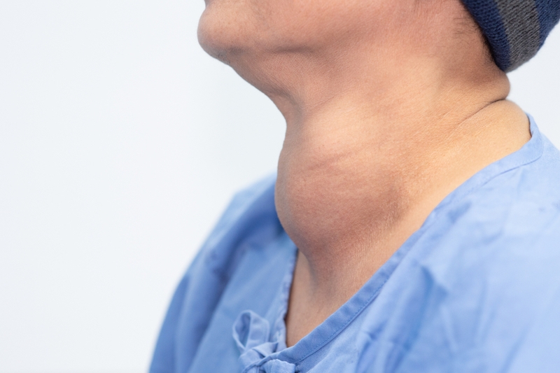 bướu cổ có mấy loại 1