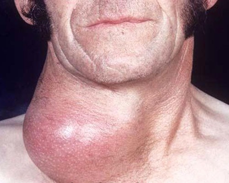 Bướu cổ giai đoạn cuối có thể sống được bao lâu? Cần lưu ý điều gì khi chăm sóc người bệnh? 1