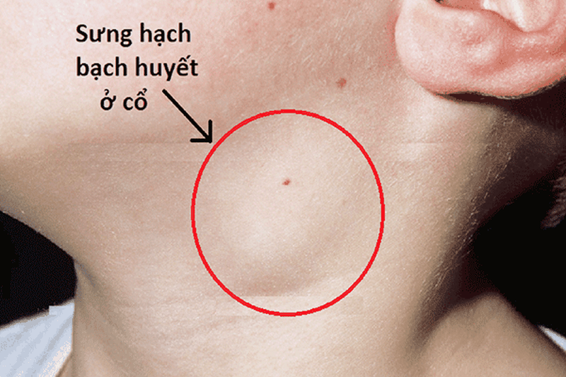 Bướu cổ giai đoạn cuối có thể sống được bao lâu? Cần lưu ý điều gì khi chăm sóc người bệnh? 2