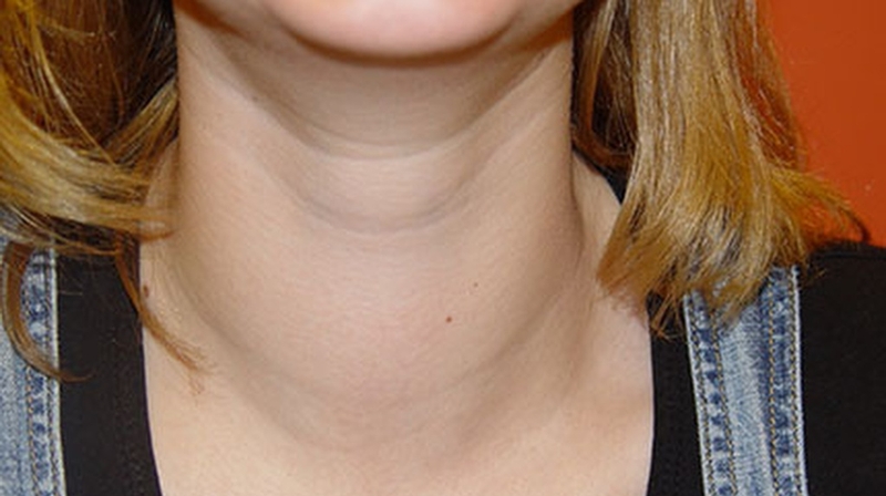 Bướu cổ giai đoạn đầu: Triệu chứng và cách chữa trị 3