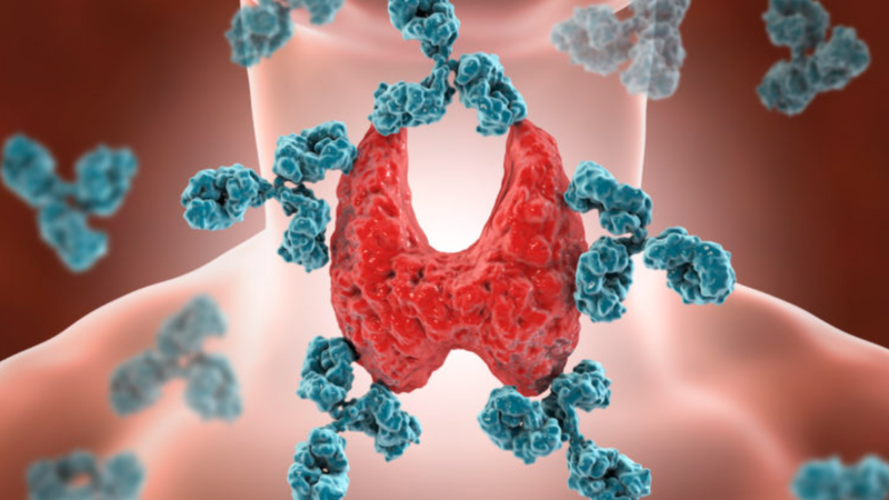 Bướu cổ giai đoạn đầu: Triệu chứng và cách chữa trị 1