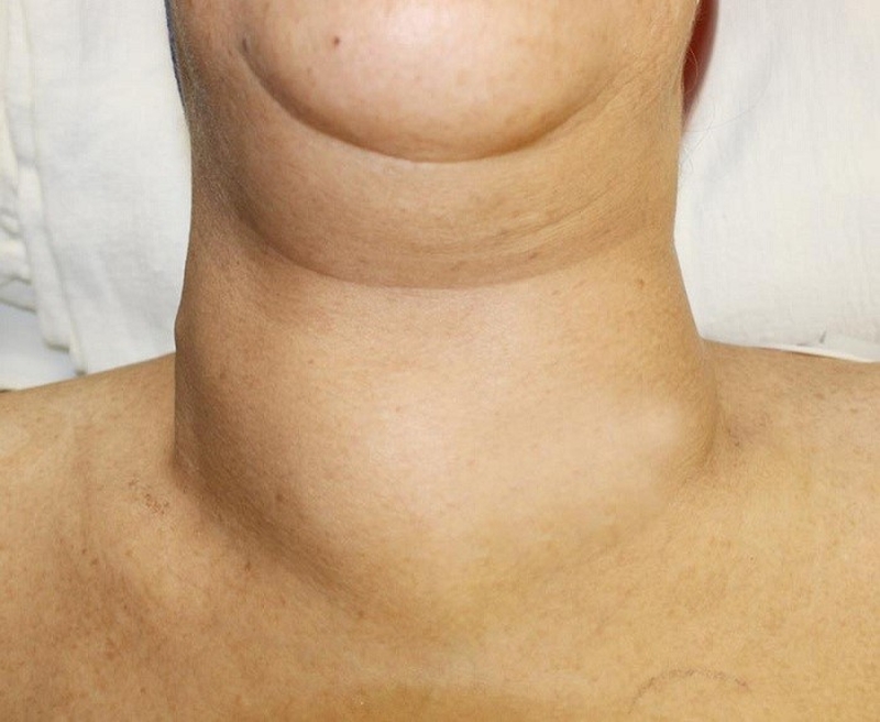 Bướu cổ giáp nhân có phải khối u ác tính hay không? Biến chứng thường gặp là gì? 1