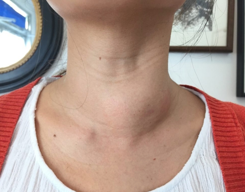 Bướu cổ là gì? Bướu cổ nằm ở vị trí nào? 1