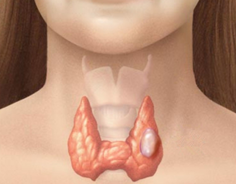 Bướu cổ là gì? Bướu cổ nằm ở vị trí nào? 2