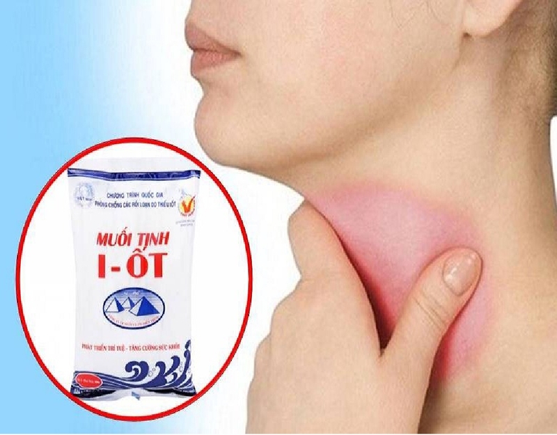 Bướu cổ là gì? Bướu cổ nằm ở vị trí nào? 3