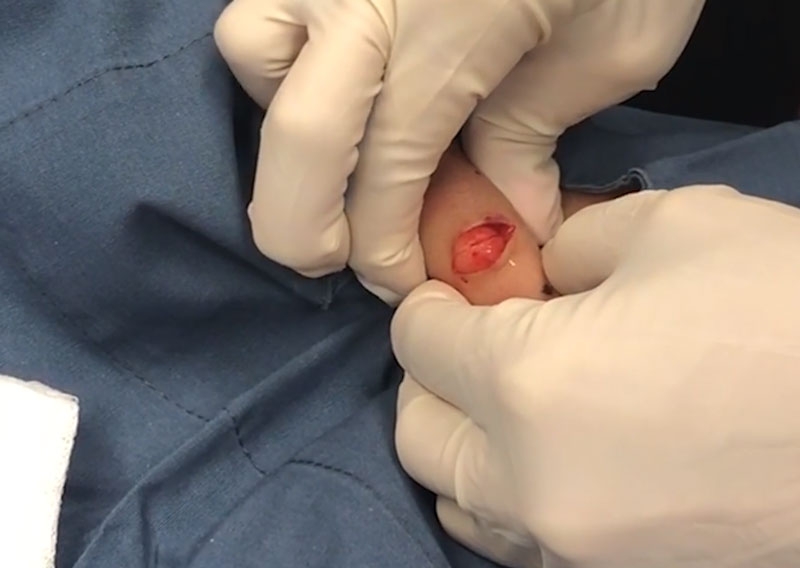 Bướu cổ mỡ là gì? Có nguy hiểm hay không? 3