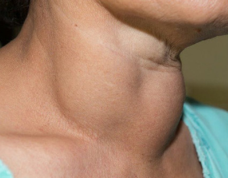 Bướu cổ nhẹ là gì? Những điều bạn cần phải làm khi bị bướu cổ 2