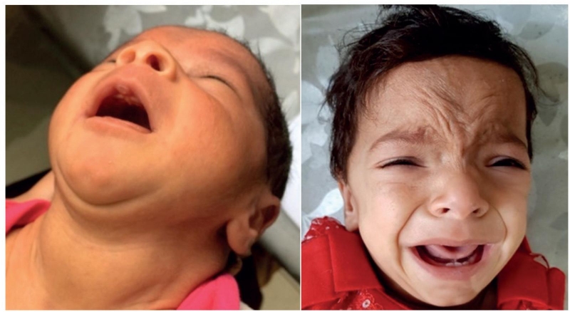 Triệu chứng bướu cổ ở trẻ em