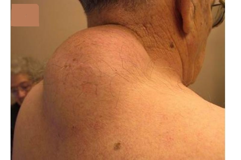 Bướu cổ sau gáy có nguy hiểm không? Cách điều trị như thế nào? 1