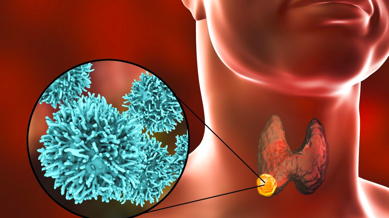 Bướu giáp nhân là gì? Nguyên nhân, triệu chứng và cách điều trị 5