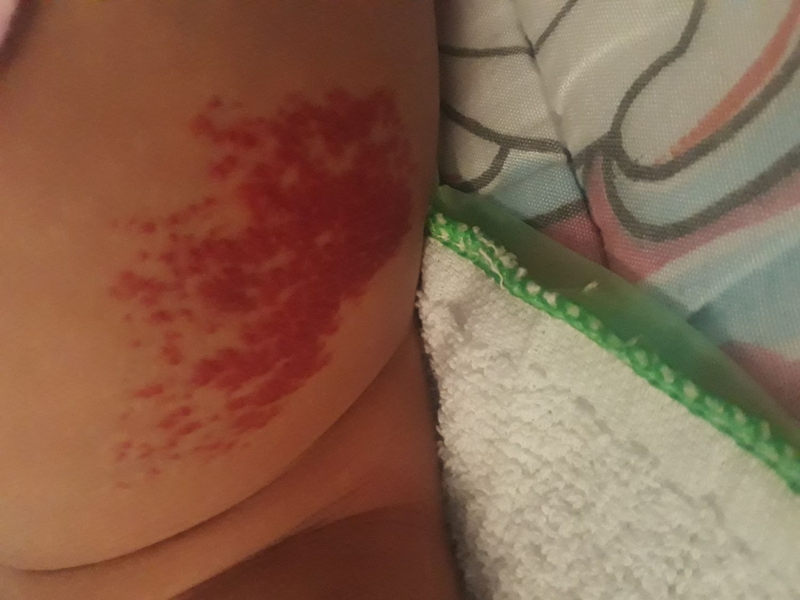 Nguyên nhân bị bướu máu ở trẻ sơ sinh: Những điều cha mẹ cần biết 3