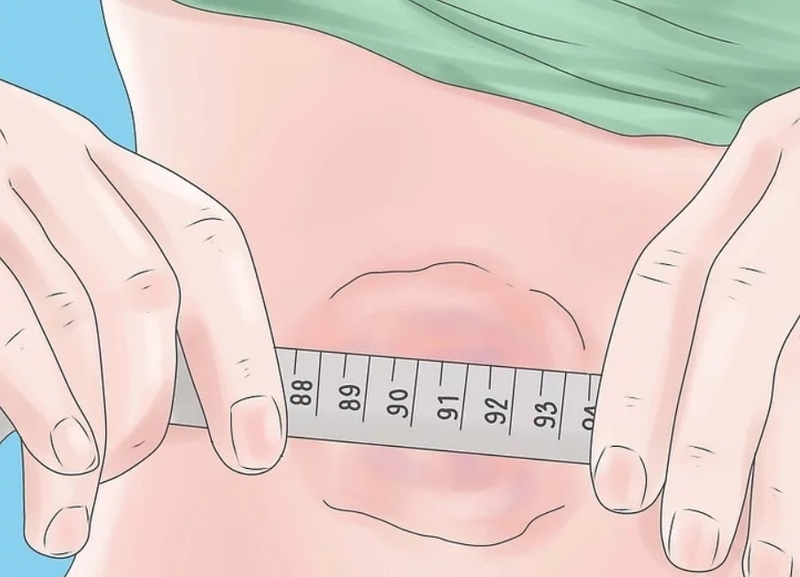 Bướu mỡ là gì? 3