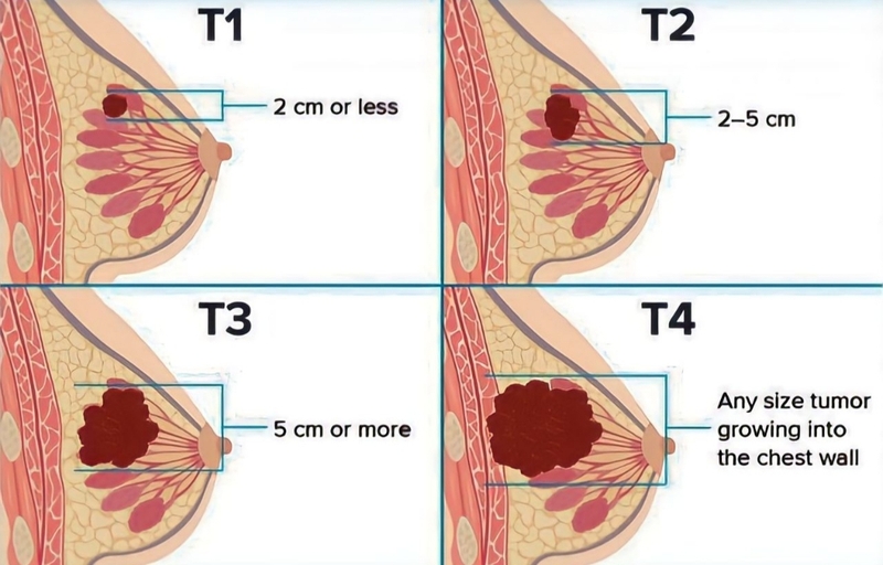 Bướu sợi tuyến Birads 4 là gì? Nguyên nhân, triệu chứng và phương pháp điều trị 4