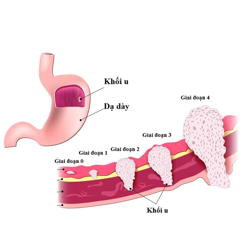 Ca 72.4 là gì? Xét nghiệm ca 72-4 có ý nghĩa gì? 2