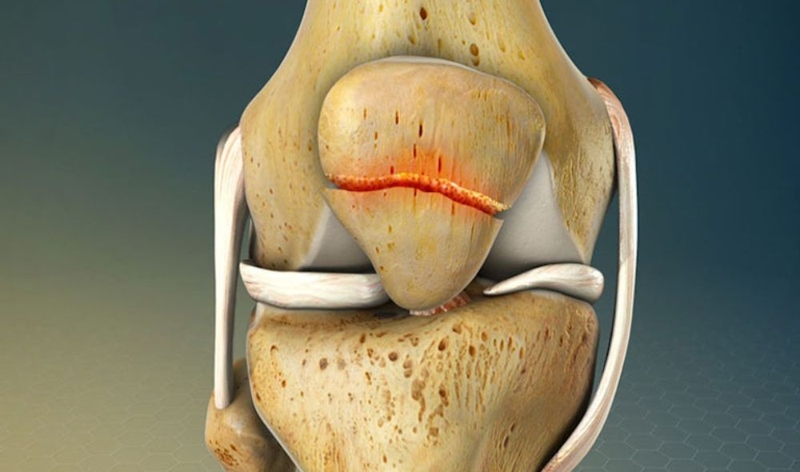 Các bài tập phục hồi chức năng vỡ xương bánh chè 1