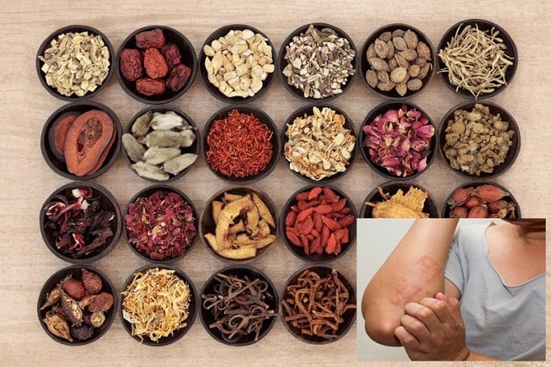 Các bài thuốc đông y trị viêm da cơ địa1