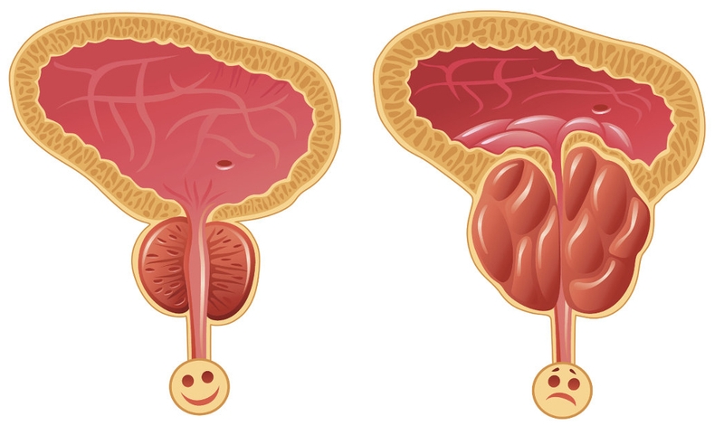 Các bài thuốc từ cây thuốc nam chữa bí tiểu tại nhà có hiệu quả không? 2