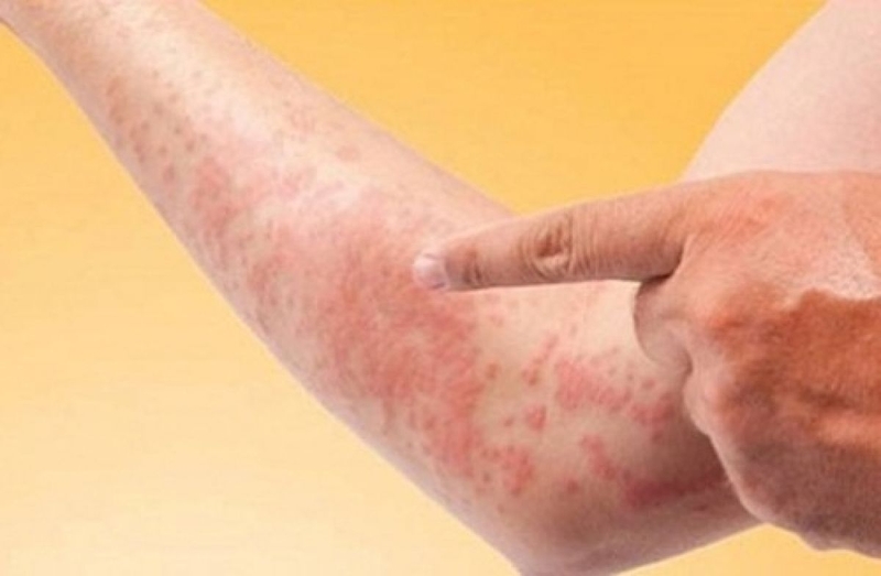 Các bệnh dị ứng thường gặp và dấu hiệu nhận biết