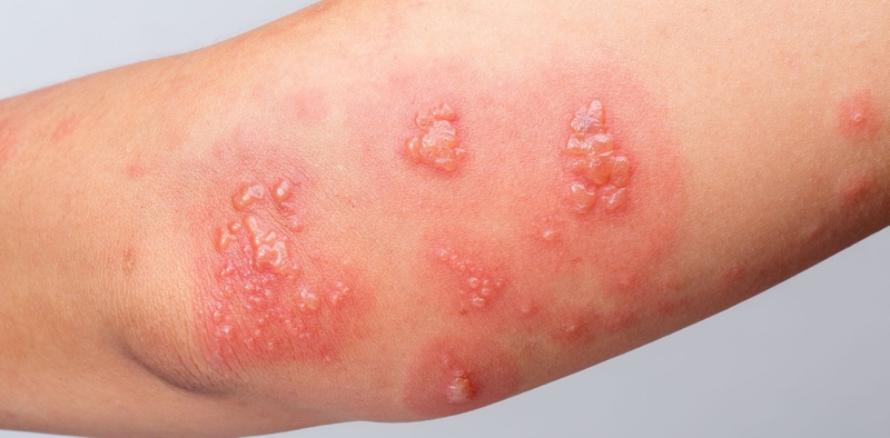 Các bệnh do vi khuẩn gây ra bạn cần hết sức chú ý 1