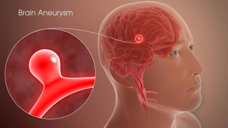 Các bệnh lý mạch máu não thường gặp 2