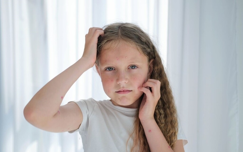 Các bệnh lý viêm da virus ở trẻ em và biện pháp phòng ngừa viêm da virus 1
