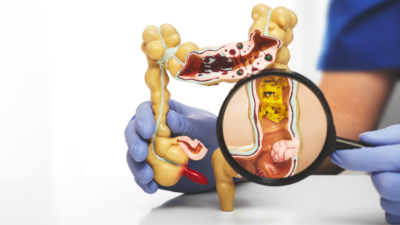 Các bệnh thường gặp ở đại trực tràng 1