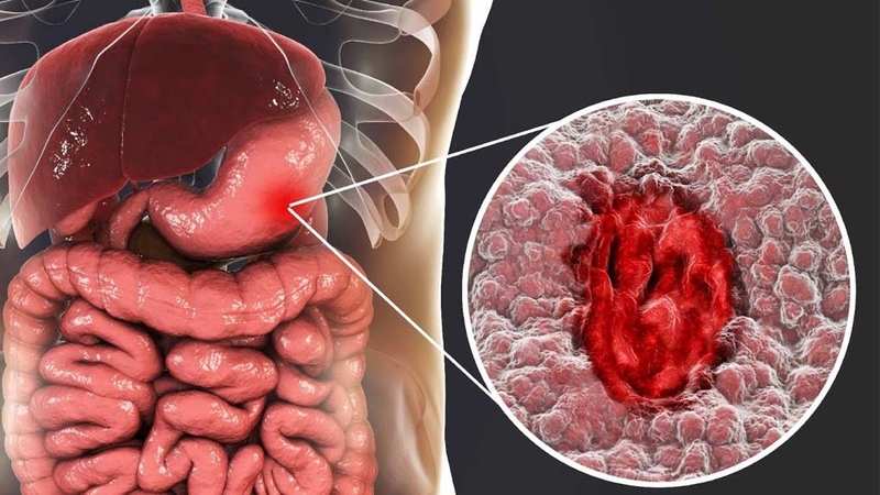 Tìm hiểu về các bệnh ung thư phổ biến và biến chứng 3