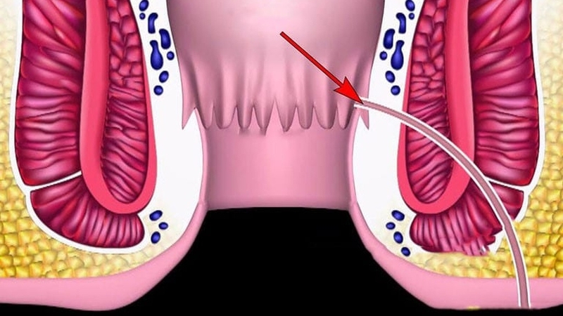 Các bệnh về hậu môn thường gặp và cách phòng ngừa 2