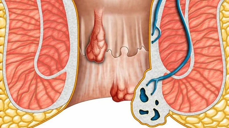 Các bệnh về hậu môn thường gặp và cách phòng ngừa 1