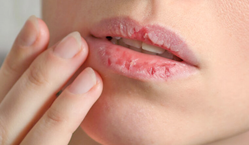 Các bệnh về môi: Nguyên nhân, triệu chứng và điều trị 2