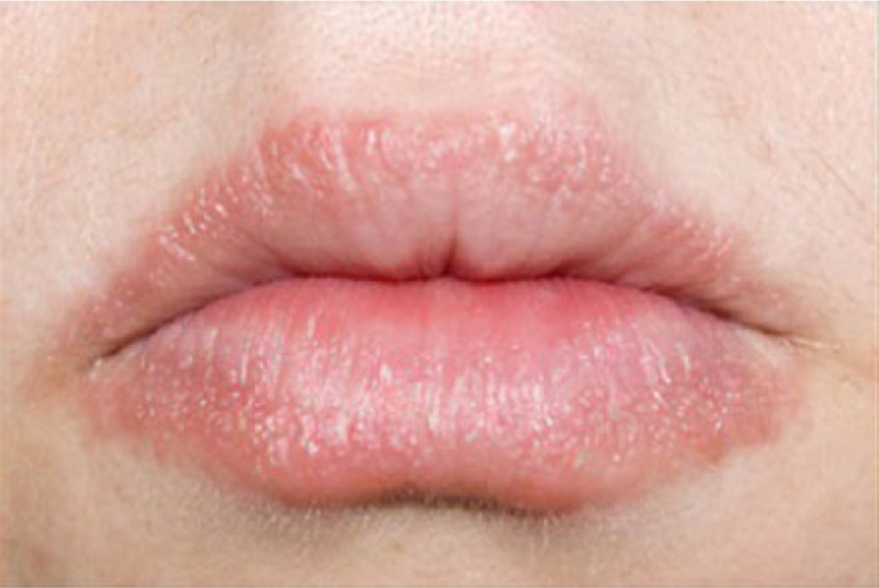 Các bệnh về môi: Nguyên nhân, triệu chứng và điều trị 3