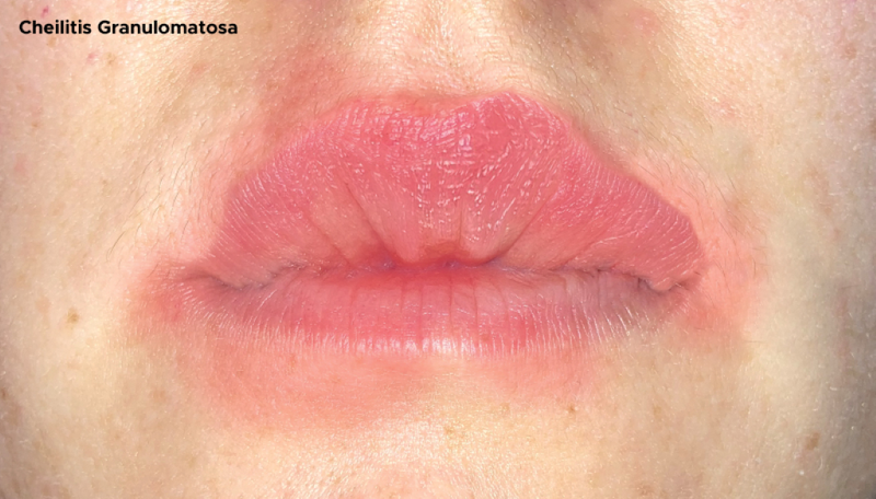 Các bệnh về môi: Nguyên nhân, triệu chứng và điều trị 4