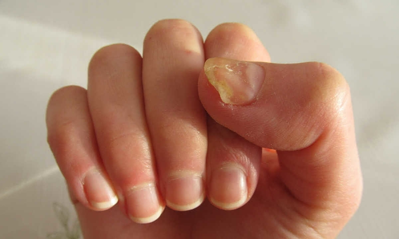 Các bệnh về móng tay phổ biến bạn không nên xem thường
