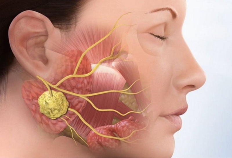 Các biến chứng quai bị: Tuyệt đối không thể chủ quan 1