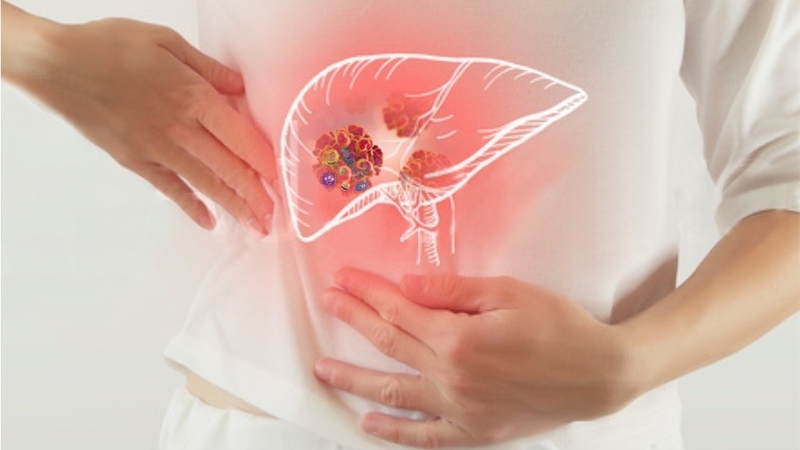 Các biến chứng thường gặp của bệnh viêm gan 4