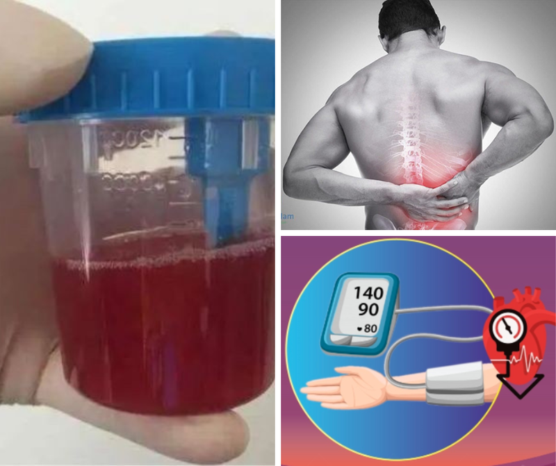 Các biến chứng thường gặp của thận đa nang 2