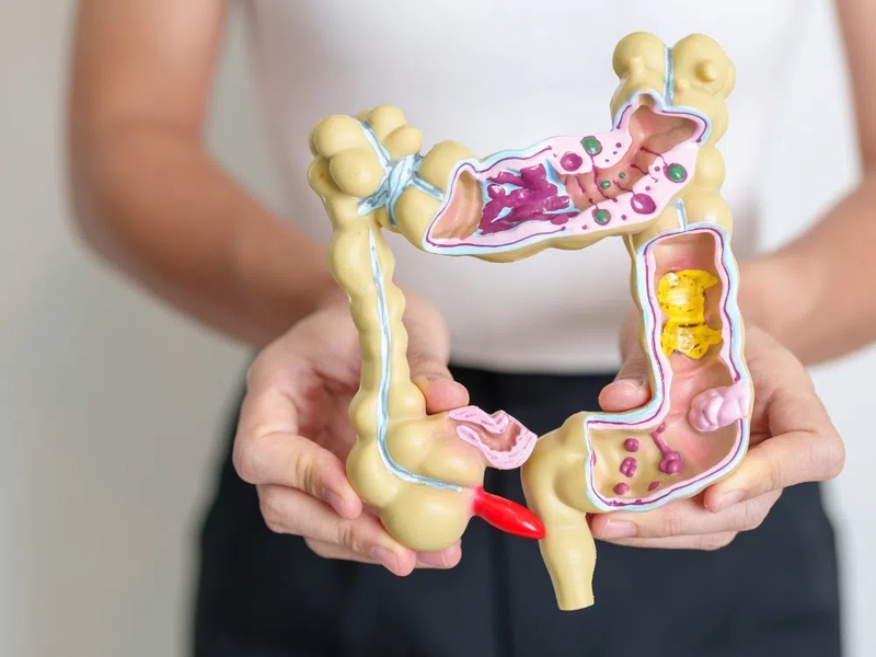 Các biến chứng thường gặp của viêm ruột thừa 4